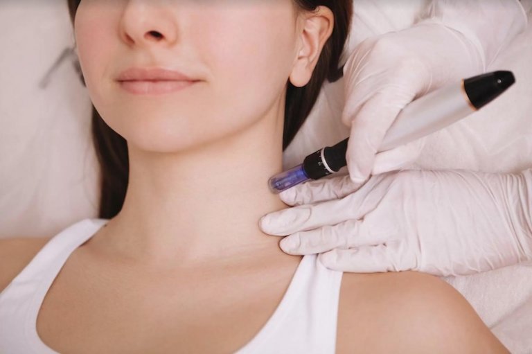 dermapen facial 2