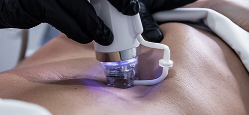 Radiofrecuencia fraccionada en abdomen